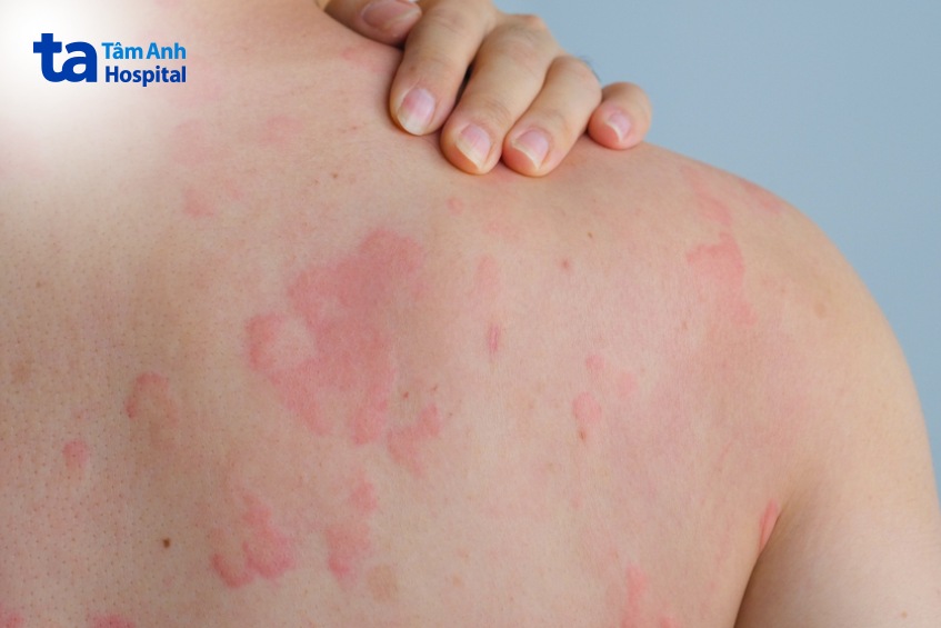 biểu hiện phổ biến khi tiếp xúc với dị nguyên