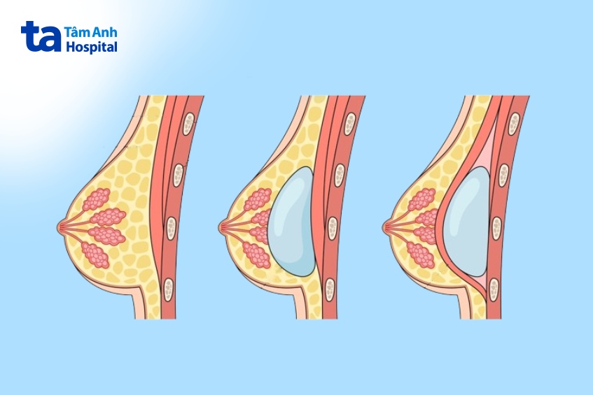 các loại túi ngực hiện nay