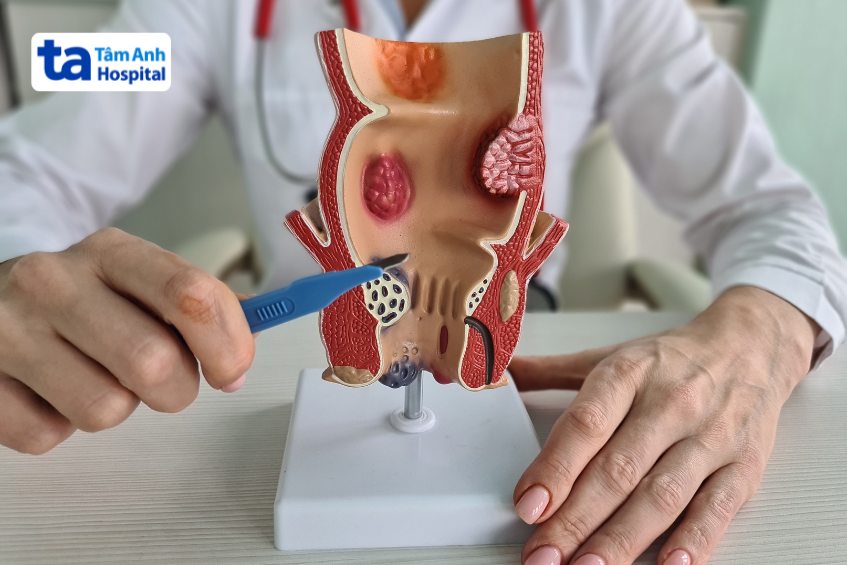 cách điều trị hẹp hậu môn