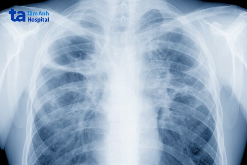 chẩn đoán bệnh xơ phổi sống được bao lâu