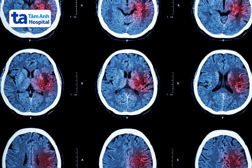 chẩn đoán điều trị xuất huyết dưới khoang nhện