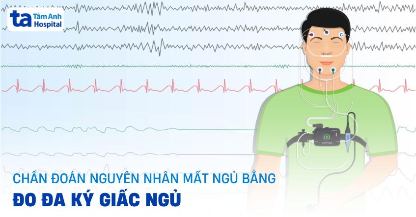 Cách chẩn đoán nguyên nhân mất ngủ bằng đo đa ký giấc ngủ