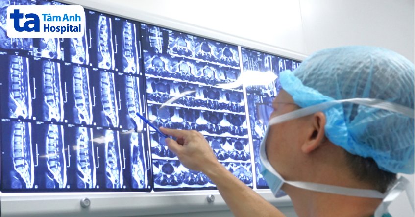 chỉ định mổ nội soi cột sống 2 cổng điều trị thoát vị đĩa đệm