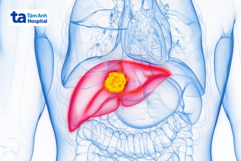 chọc hút nang gan