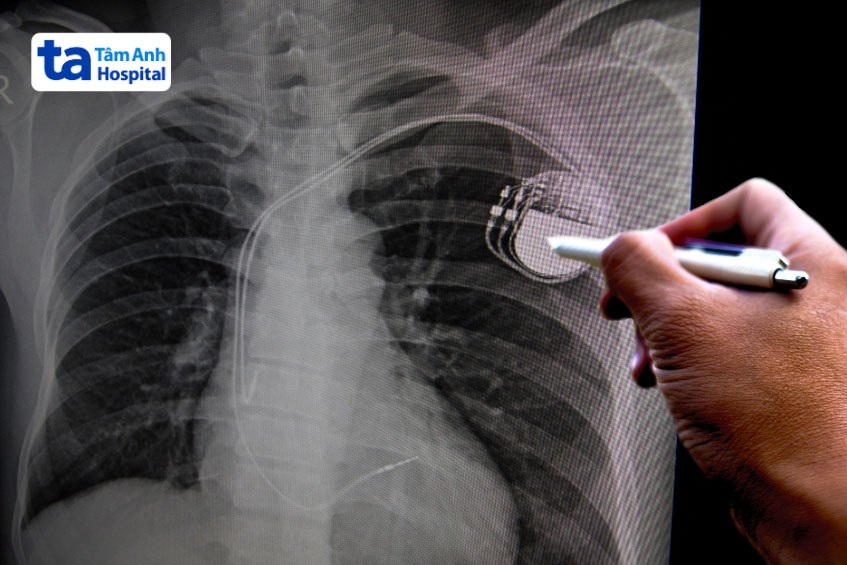 Chụp X Quang ngực thẳng được chỉ định thực hiện sau khi bệnh nhân được gắn máy tạo nhịp tim
