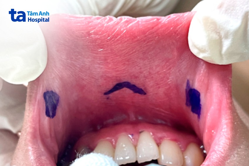 đánh dấu phẫu thuật nội soi tuyến giáp qua đường miệng