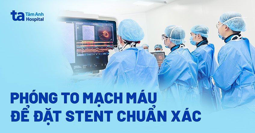 Đặt stent chuẩn xác nhờ soi ngóc ngách mạch máu