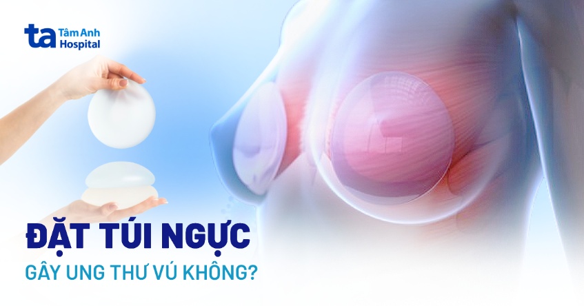Đặt túi ngực có gây ung thư vú không? Có là yếu tố nguy cơ không?
