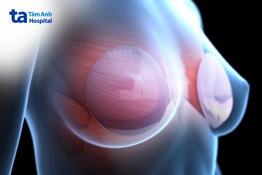 đặt túi ngực có thể gây ung thư vú không