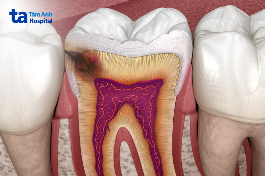 Nguyên nhân đau răng hàm