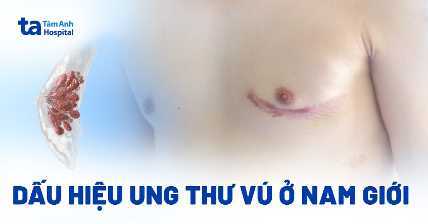 9 dấu hiệu ung thư vú ở nam giới cần nhận biết sớm, đừng chủ quan