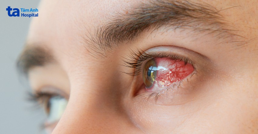 đeo kính áp tròng viêm giác mạc rất nguy hiểm