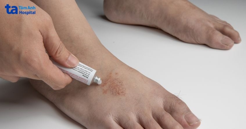 điều trị bệnh hắc lào