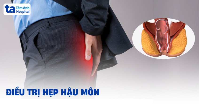 5 phương pháp điều trị hẹp hậu môn an toàn và hiệu quả