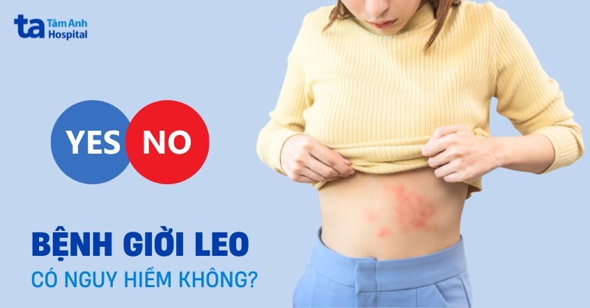 Giời leo có nguy hiểm không? Biến chứng có ảnh hưởng tính mạng?