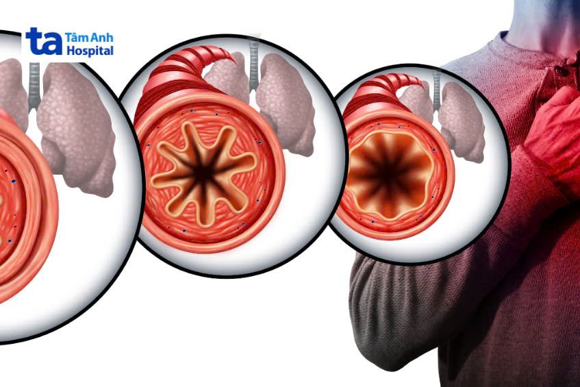 hen suyễn gây tắc nghẽn đường hô hấp dưới