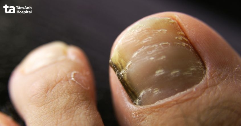 hình ảnh bệnh nấm móng chân