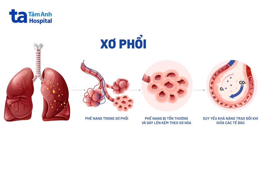 hình ảnh bệnh xơ phổi