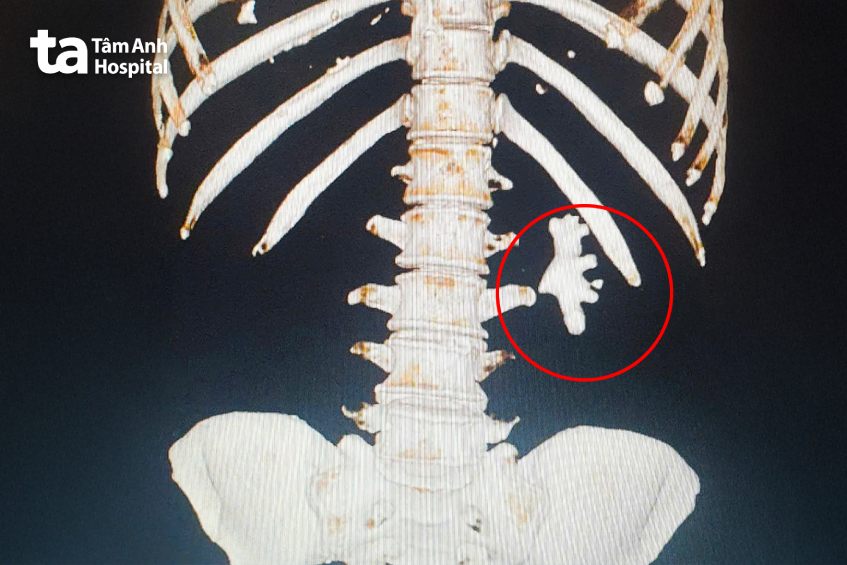 hình ảnh chụp ct scan khối sỏi