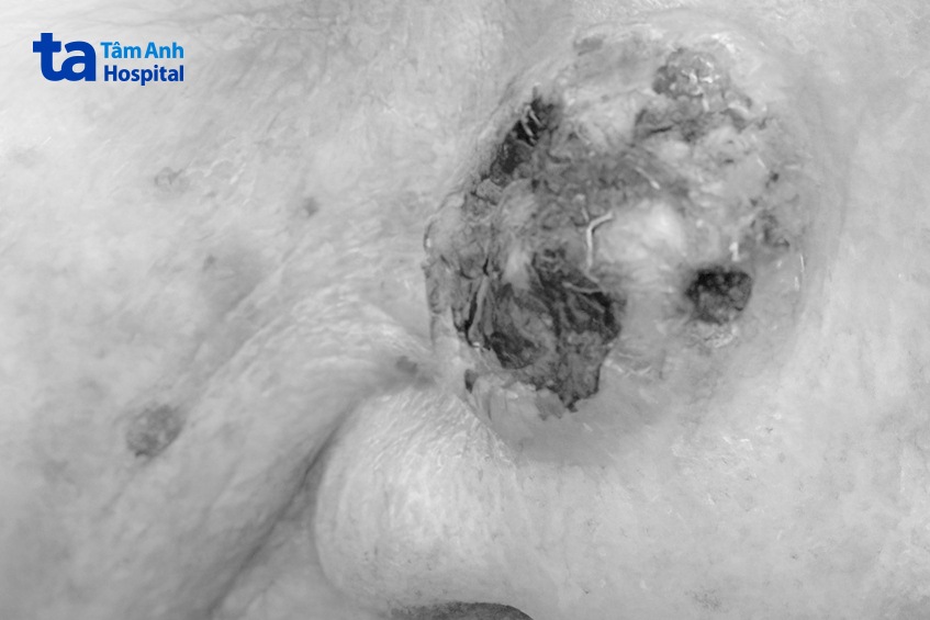 hình ảnh nốt ruồi ung thư da bị lở loét