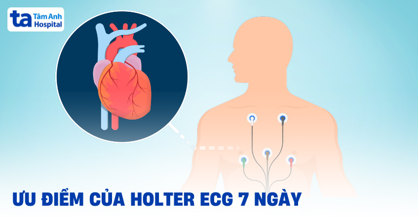 Đo Holter ECG 7 ngày khi nào? Ưu điểm, quy trình và lưu ý [A-Z]