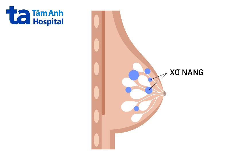 hướng điều trị của xơ nang tuyến vú