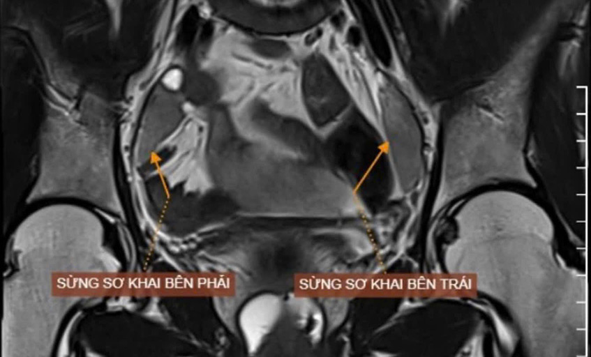 Kết quả chụp MRI vùng chậu không thấy tử cung