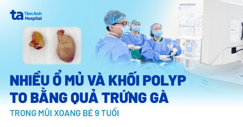 Nhiều ổ mủ và khối polyp to bằng quả trứng gà trong mũi xoang bé 9 tuổi