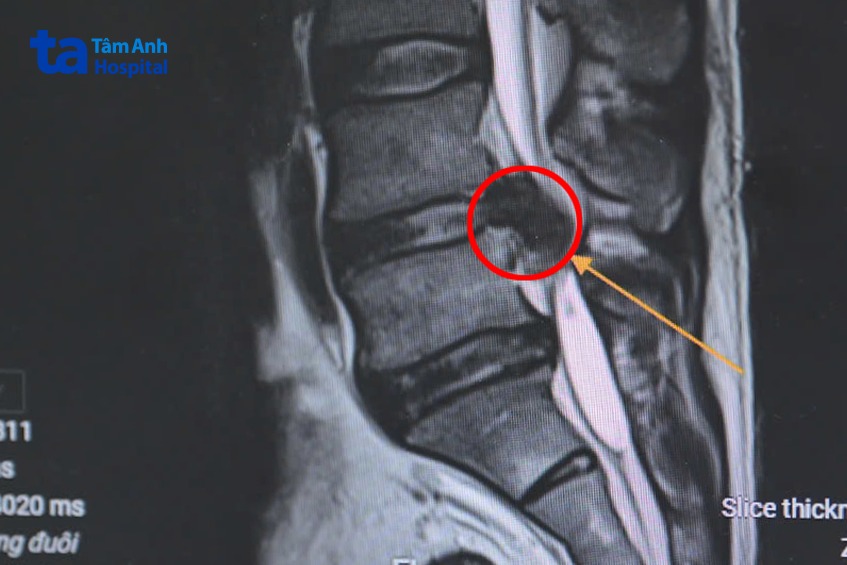 khối thoát vị lớn gây chèn ép gần hết ống sống