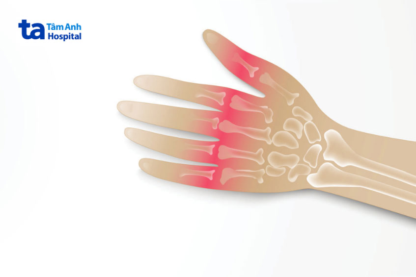 khớp ngón tay bị thoái hóa