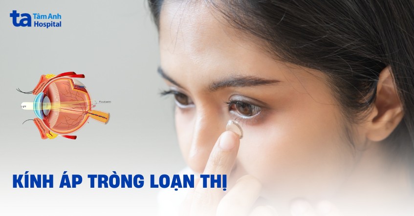 Kính áp tròng loạn thị: Phân loại, ưu nhược điểm và cách sử dụng