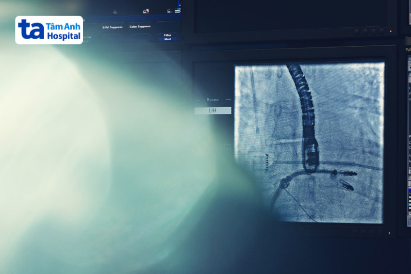 Kỹ thuật MitraClip giúp kẹp chặt hai mép van hở