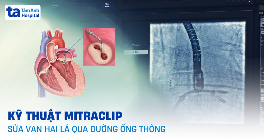 MitraClip sửa van hai lá qua đường ống thông: Ưu điểm và chỉ định