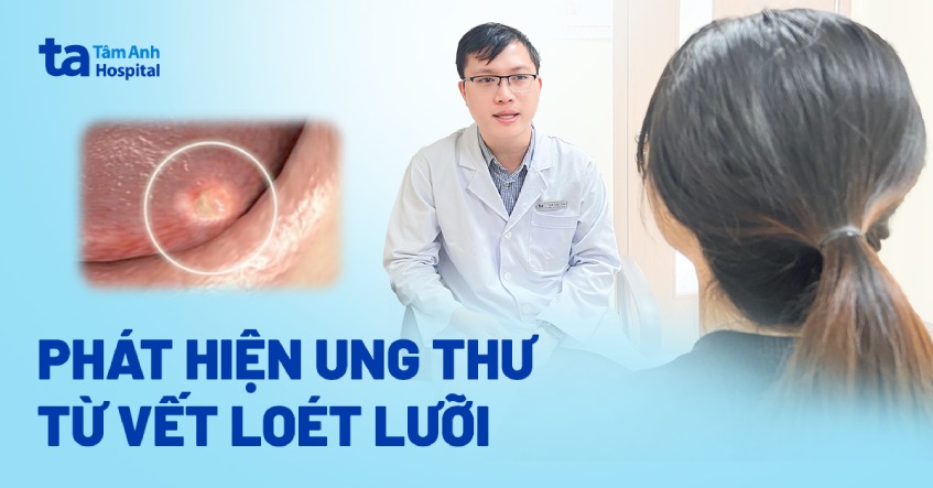 Loét miệng phát hiện ung thư lưỡi