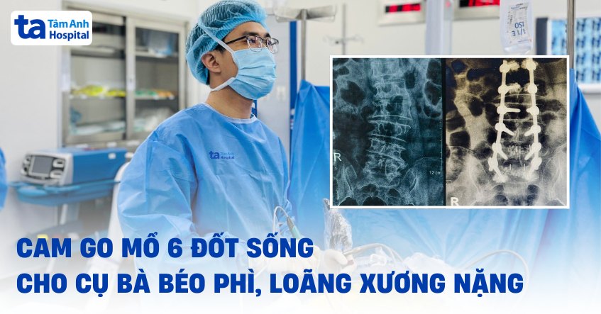 Cam go mổ sáu đốt sống cho cụ bà béo phì, loãng xương nặng