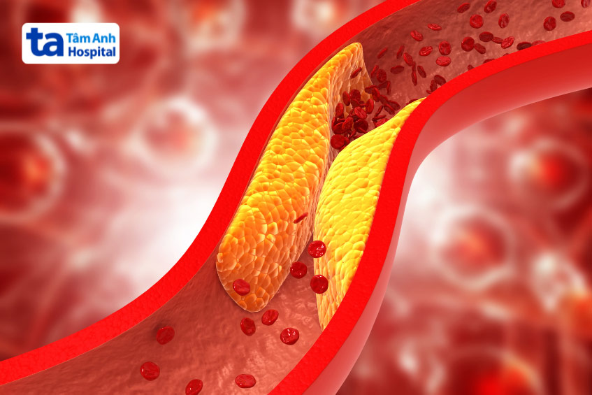 Mỡ máu cao tích tụ tạo nên các mảng bám gây tắc nghẽn trong lòng động mạch