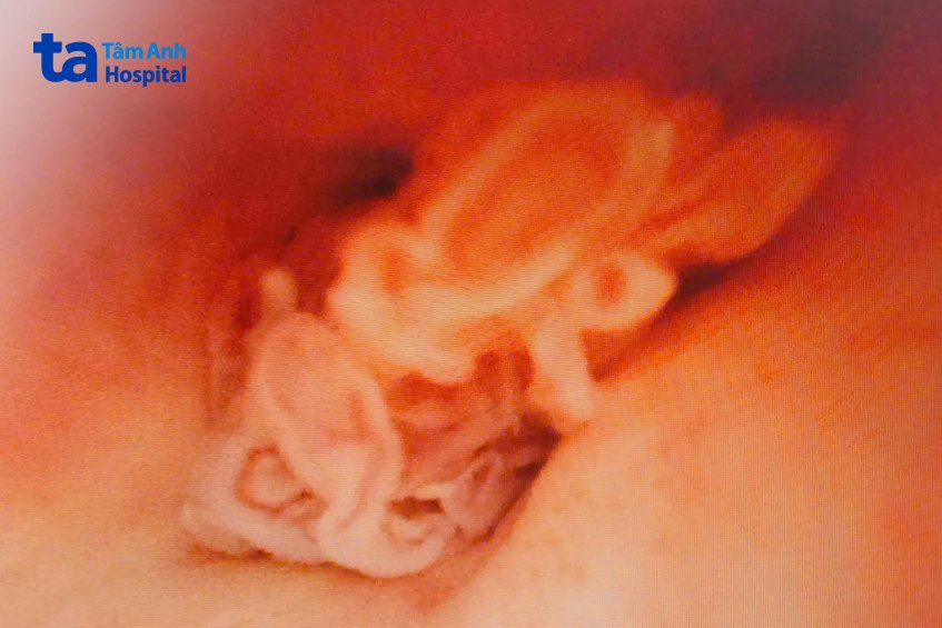 một khối u ác tính trong niệu đạo của ông k