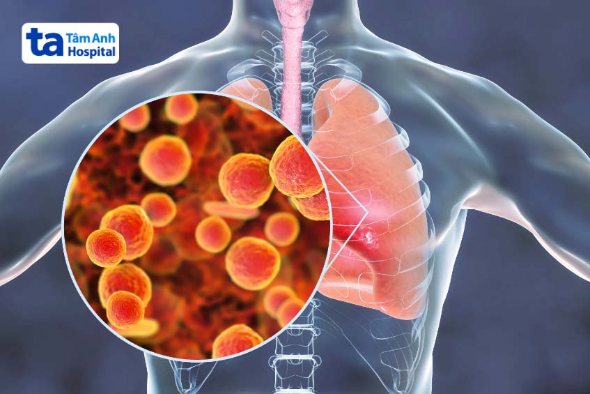 mycoplasma viêm phổi