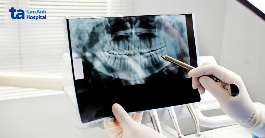 Các cách phẫu thuật nang nhái sàn miệng