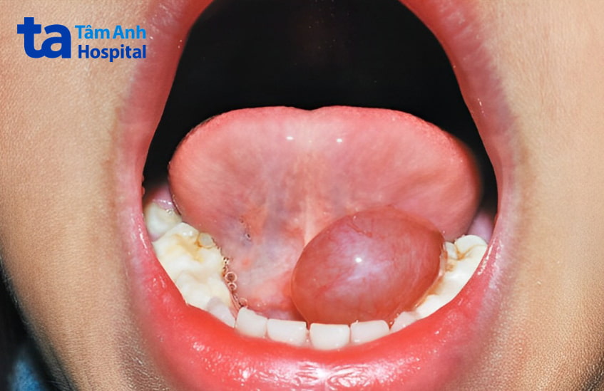 Nang nhái sàn miệng là gì?