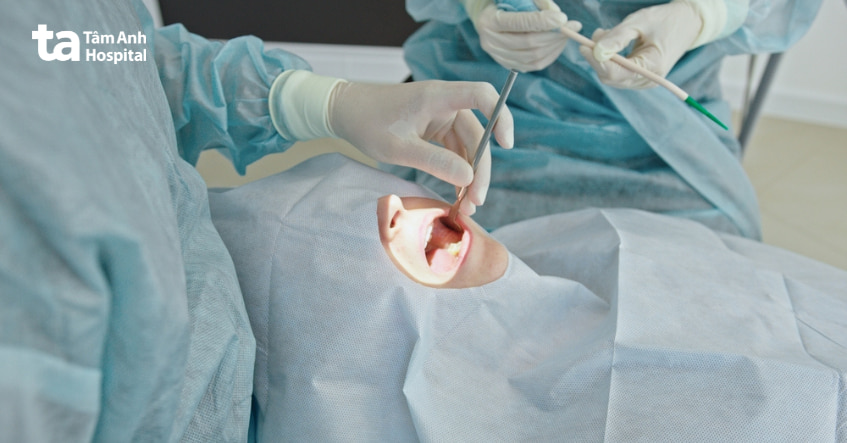 Phương pháp điều trị nang nhái sàn miệng