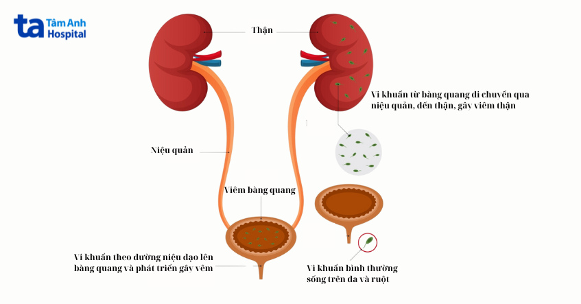 nhiễm trùng đường tiết niệu