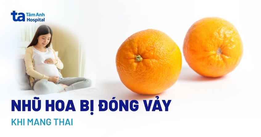 Nhũ hoa bị đóng vảy khi mang thai: Nguyên nhân và cách điều trị