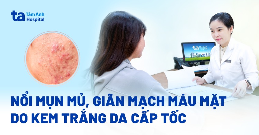 nổi mụn mủ giãn mạch máu cho kem trắng da cấp tốc