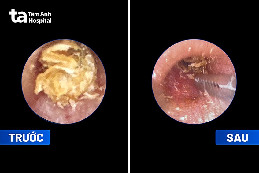 nội soi lấy ráy tai
