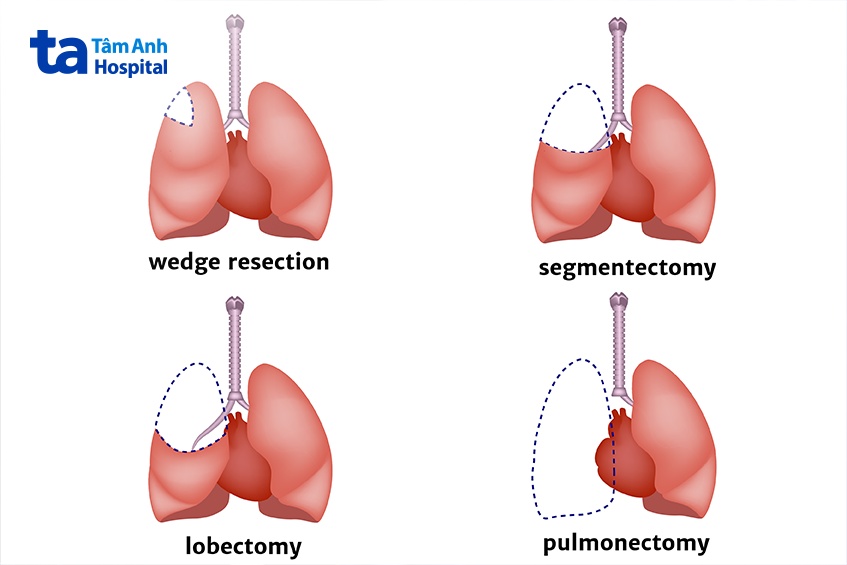 phẫu thuật cắt thùy phổi là gì