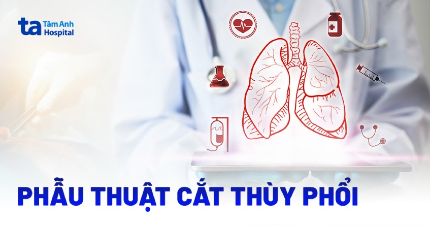 Phẫu thuật cắt thùy phổi: Khi nào phải mổ? Quy trình là gì?