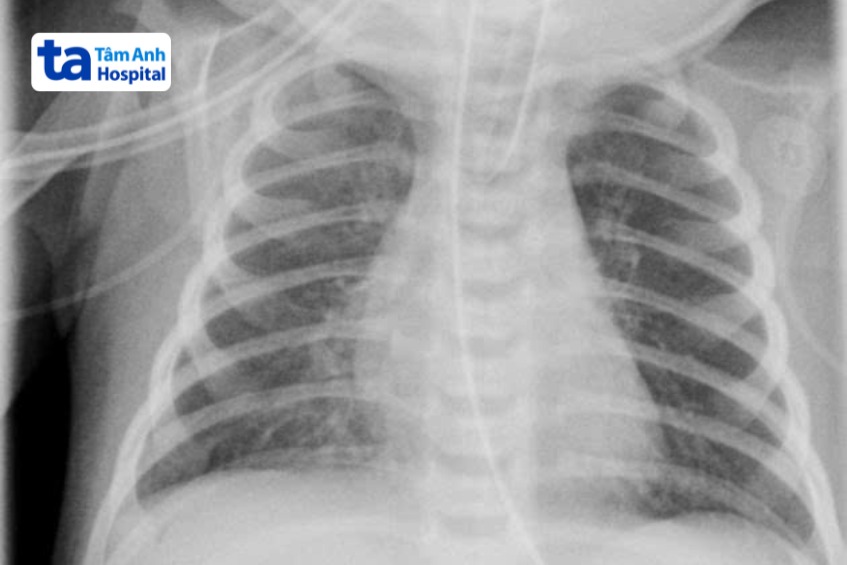 phim x - quang của trẻ sơ sinh bị viêm phổi