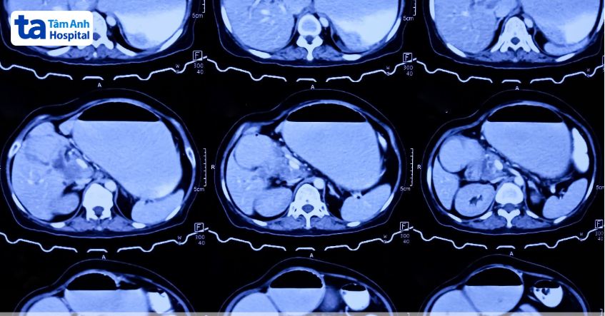 phương pháp cắt gist dạ dày