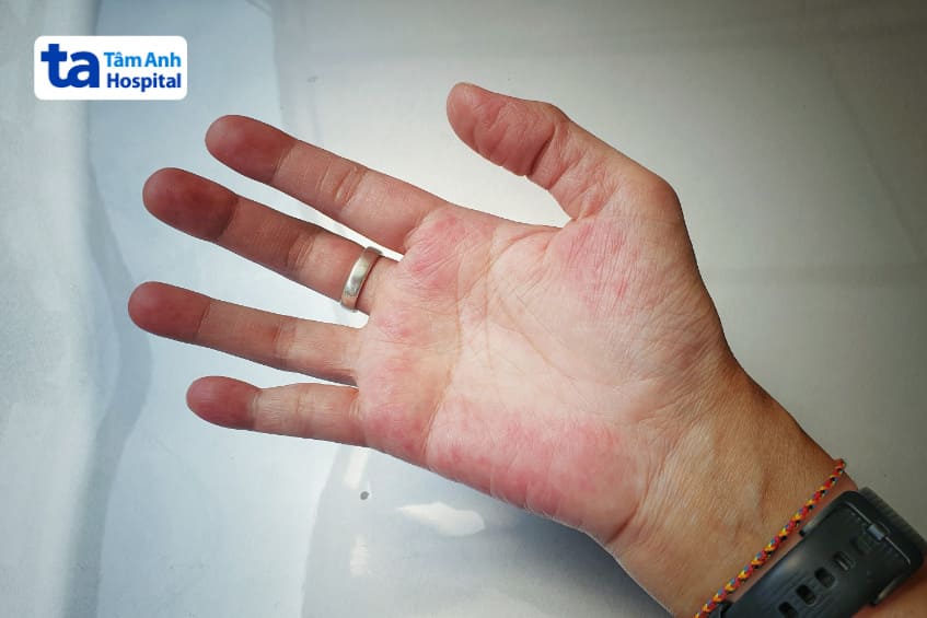 ppi có liên quan đến trường hợp lupus ban đỏ cấp trên da